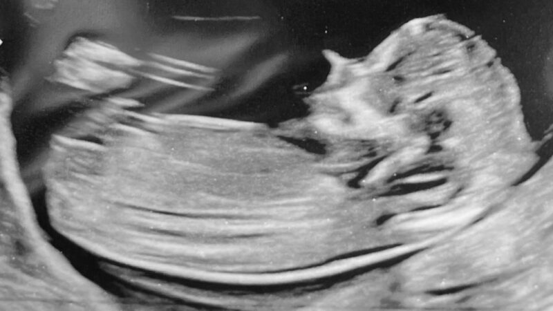 Sonogram, courtesy of the author