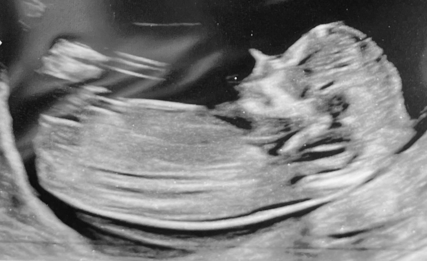 Sonogram, courtesy of the author